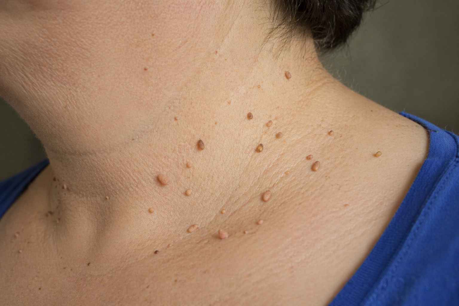 Acrocordones en el cuello tratados con láser CO2 en Madrid Sur