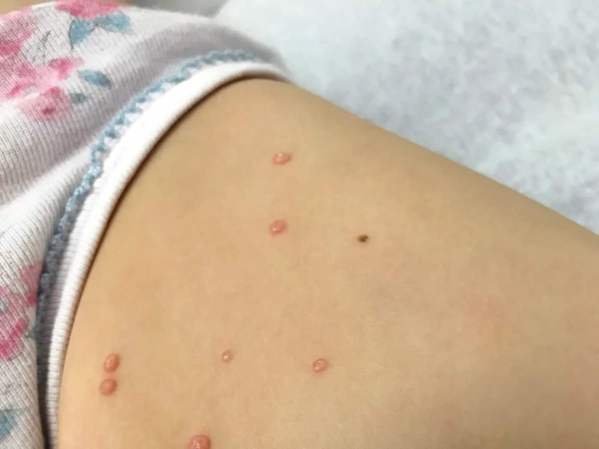 Moluscos contagiosos en la piel de un niño