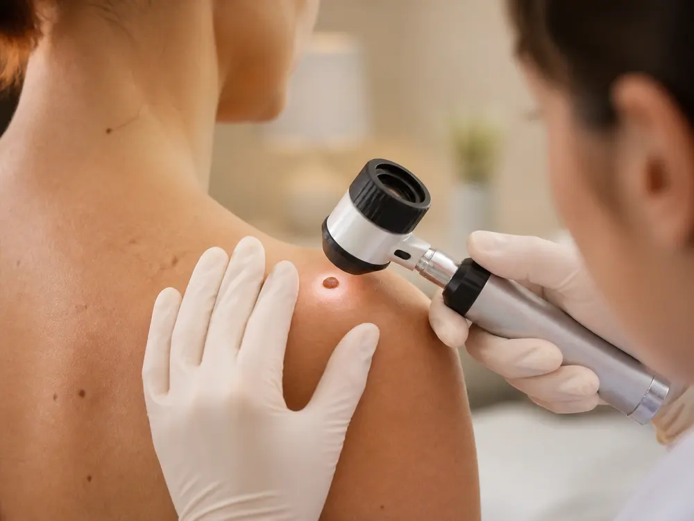 Dermatóloga examinando una lesión pigmentada con dermatoscopio