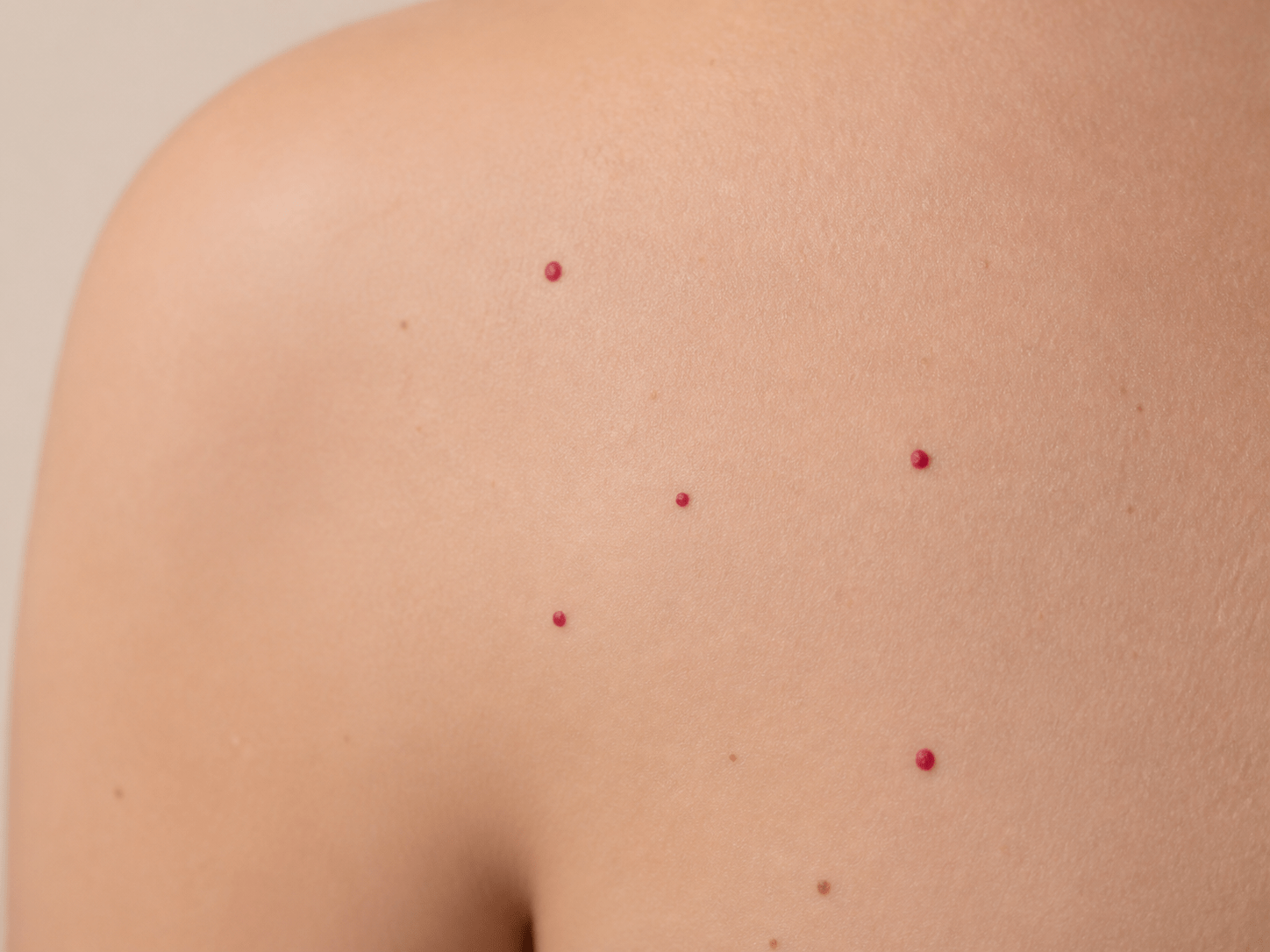 Angiomas y puntos rubí